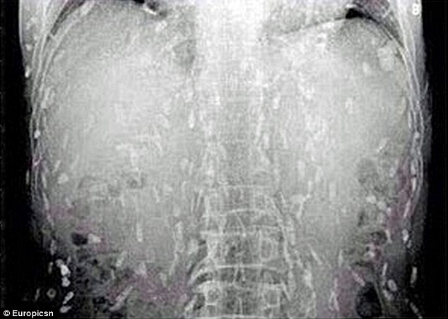 One man's love of sashimi nearly killed him after it led to his body becoming riddled with tapeworm parasitres